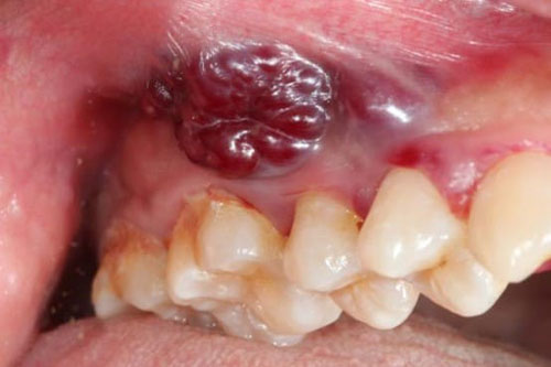 Ung thư nướu răng
