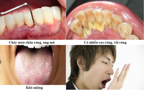Bệnh lý răng miệng gây hôi miệng