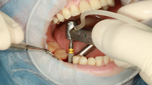Các yếu tố ảnh hưởng tới thời gian trồng răng Implant