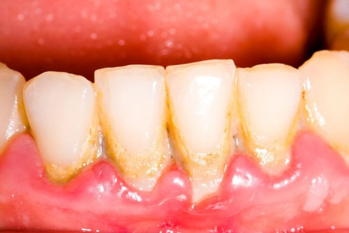 Cao răng tái bám lâu ngày gây ê buốt răng