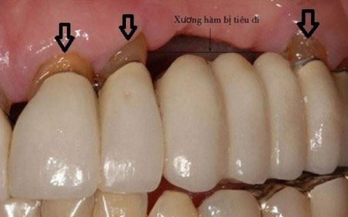 Cầu răng sứ hở gây nhiều biến chứng