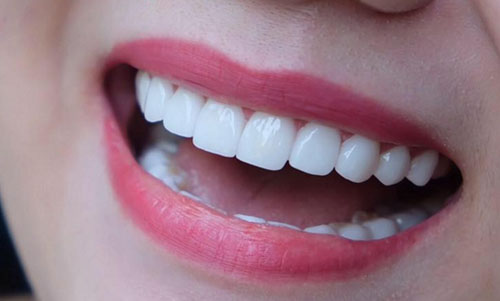 Làm răng sứ ĐẸP và chuẩn xác cần những yếu tố nào?