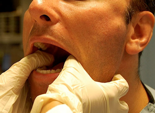 Dấu hiệu và triệu chứng bệnh đau quai hàm