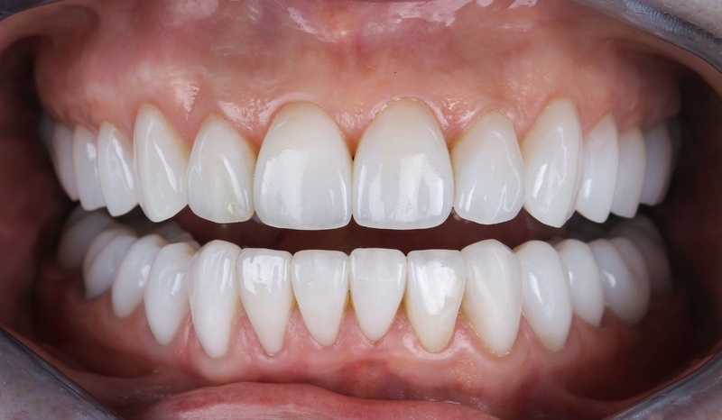 Dòng răng sứ Zirconia mang lại tính thẩm mỹ vượt trội