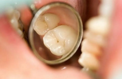 Giai đoạn chớm sâu răng