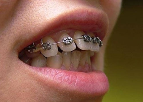 Hô hàm có niềng răng được không?