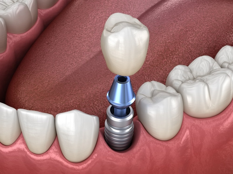 Kỹ thuật cấy ghép Implant