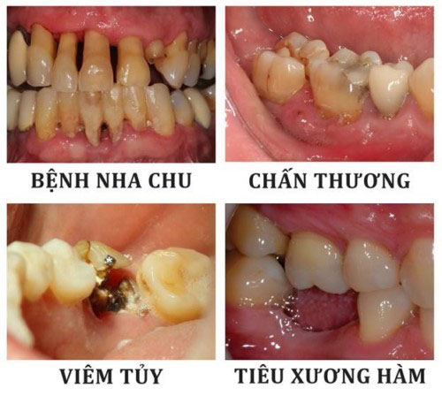 Nguyên nhân khiến răng bị lung lay