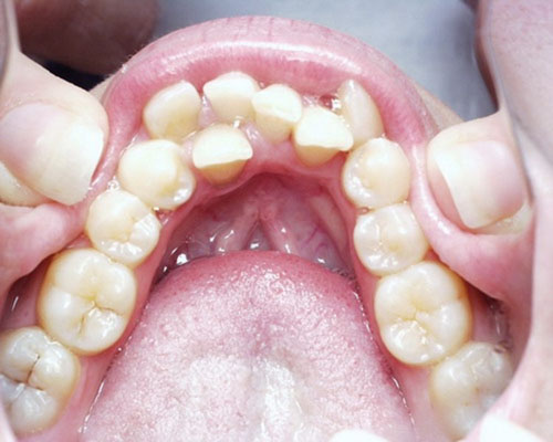 Nguyên nhân mọc răng thừa thường gặp