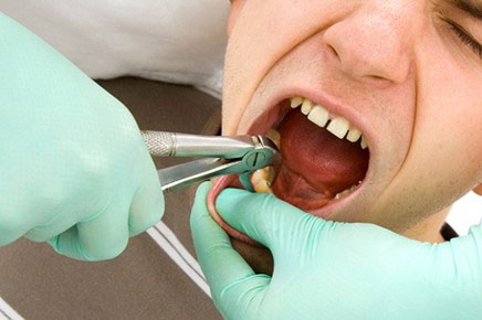 Nhổ răng khôn mọc thẳng có đau không?