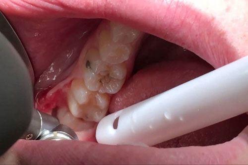 Nhổ răng khôn mọc thẳng tốn thời gian bao lâu?