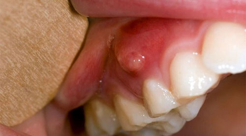 Quá trình hình thành áp xe răng