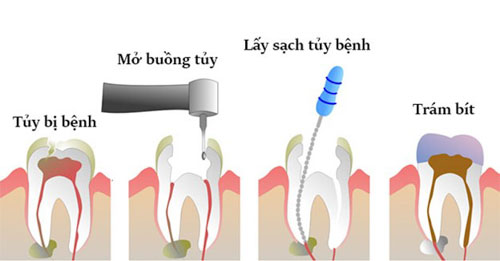Quy trình điều trị tủy răng