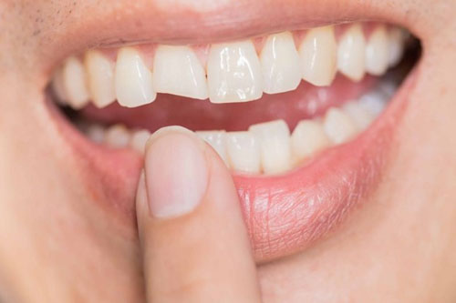 Răng gãy mẻ gây lộ ngà răng