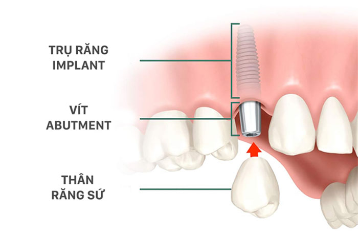 Răng Implant có cấu trúc hoàn chỉnh không khác gì răng thật
