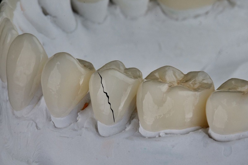 Răng sứ giá rẻ có thể gây nứt gãy trong quá trình sử dụng