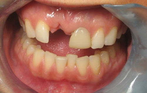Sau khi nhổ răng bao lâu thì có thể tiến hành trồng răng