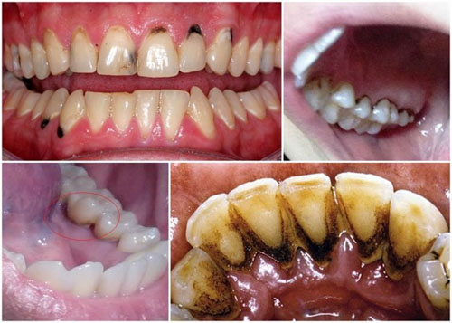 Sâu răng gây đen mặt trong răng