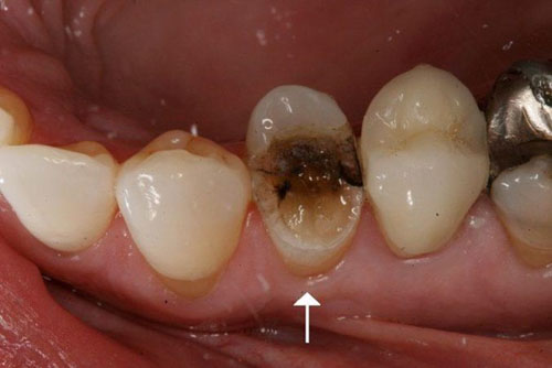 Sâu răng vỡ lớn ảnh hưởng tủy răng