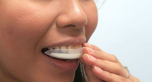 Tẩy trắng răng không đúng cách gây ê buốt