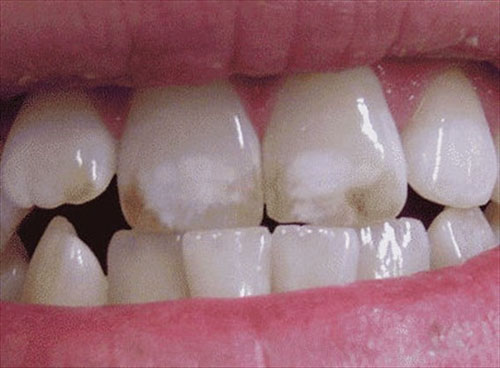 Thiếu sản men răng