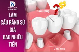 chi phí làm cầu răng sứ giá bao nhiêu tiền 4