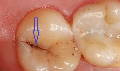 Răng bị nứt rất khó để tự phục hồi