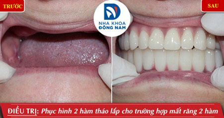 Phục hình hàm giả tháo lắp cho bệnh nhân mất răng 2 hàm