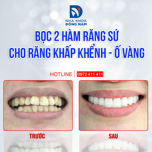 Bọc răng sứ giúp khắc phục tình trạng hô do răng mức độ nhẹ