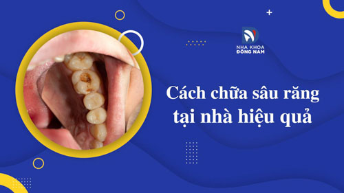 Cách Chữa Bệnh Sâu Răng Tại Nhà Hiệu Quả – nha khoa Đông Nam