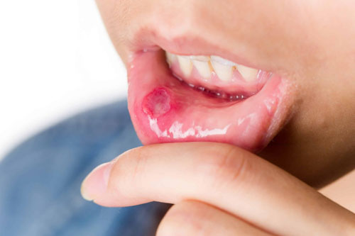 Giai đoạn ổ loét của bệnh nhiệt miệng