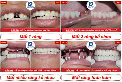 Hình ảnh thực tế của khách hàng sau khi trồng răng Implant