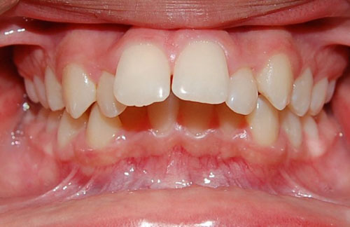 Hô do cả răng và hàm