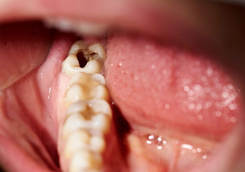 Lỗ hổng sâu răng dễ khiến thức ăn kẹt vào