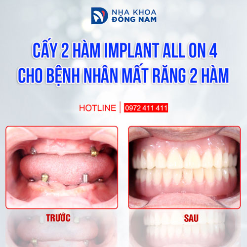 Phục hình bằng kỹ thuật Implant All On 4 cho bệnh nhân mất răng 2 hàm