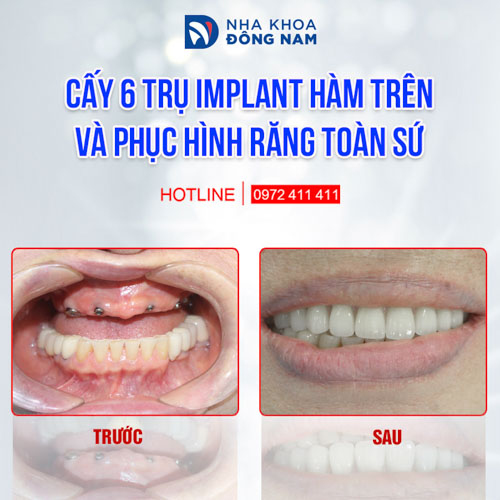 Phục hình bằng kỹ thuật Implant All On 6 cho bệnh nhân mất răng toàn hàm trên