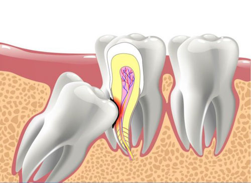 Răng khôn mọc lệch có thể gây hư hỏng răng số 7 kế bên