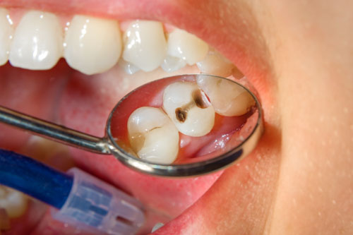Răng sâu mức độ nhẹ có thể phục hồi bằng phương pháp hàn trám hoặc bọc răng sứ