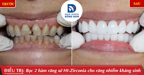 Răng sứ HI-Zirconia được đánh giá rất cao về thẩm mỹ và độ bền chắc