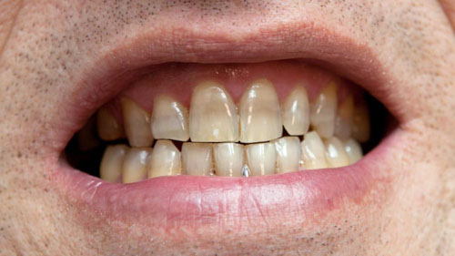 Tẩy trắng răng không có tác dụng với tình trạng răng nhiễm Tetracycline