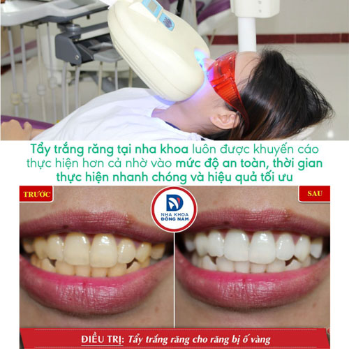 Tẩy trắng răng tại nha khoa an toàn và mang lại hiệu quả cao