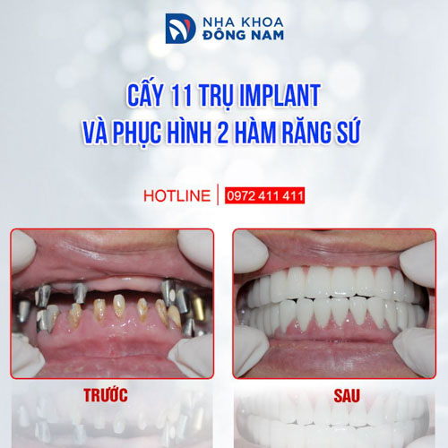 Tính thẩm mỹ và độ bền chắc của răng Implant được đánh giá rất cao