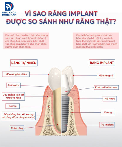 Trồng răng Implant có cấu trúc tương tự như răng thật