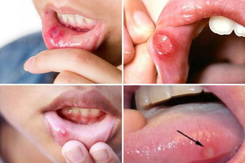 Vết loét nhiệt miệng thường gây đau nhức khó chịu