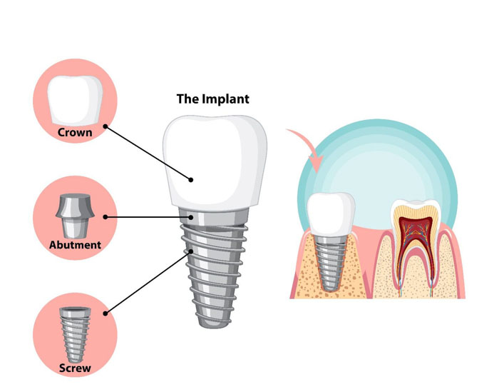 Cấu tạo của răng Implant đầy đủ thân và chân răng