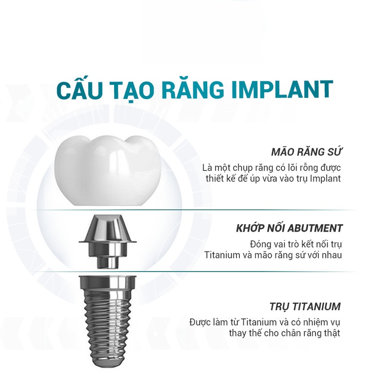 Cấu tạo của răng Implant