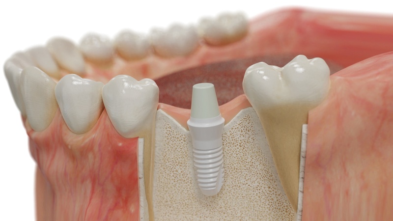 Cấy Implant cho những trường hợp đã nhổ hẳn chân răng