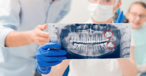Chụp X - Quang kiểm tra tình trạng răng khôn
