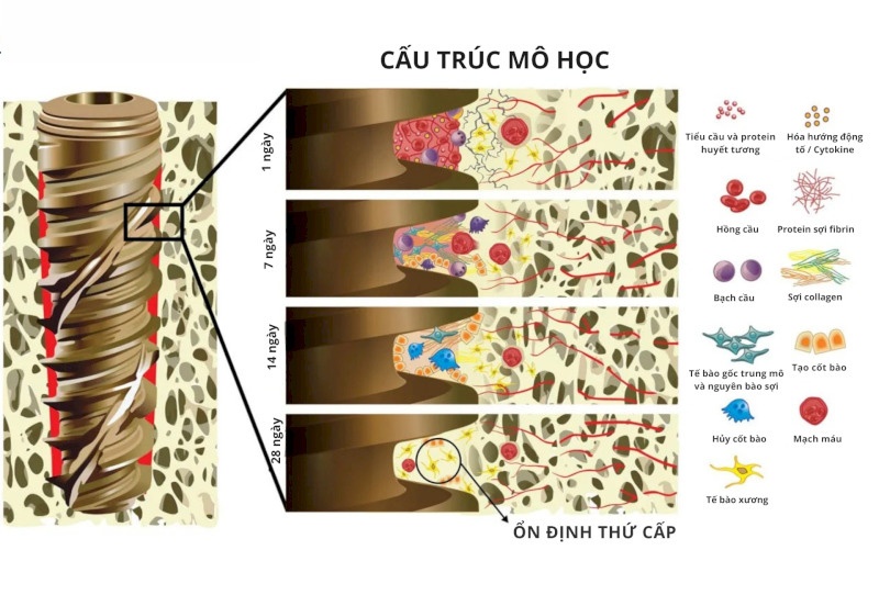 Giai đoạn trụ Implant lành thương sau 1 tháng