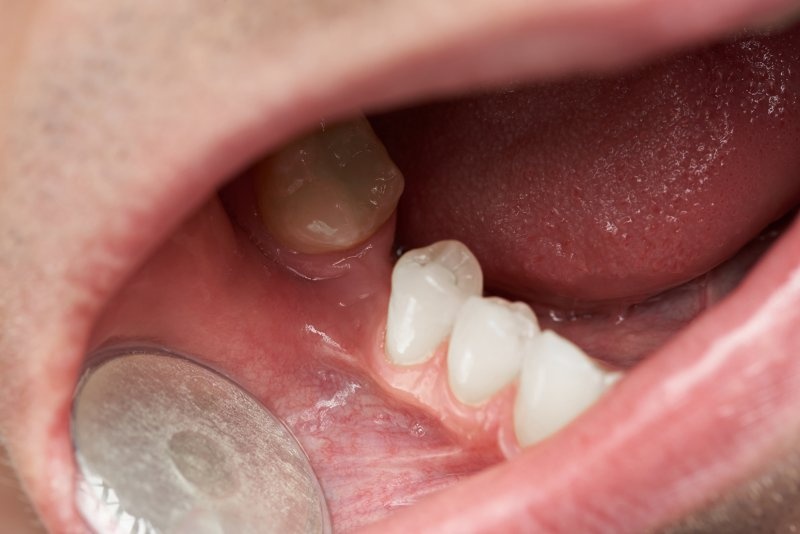 Mất răng gây tiêu xương hàm nghiêm trọng